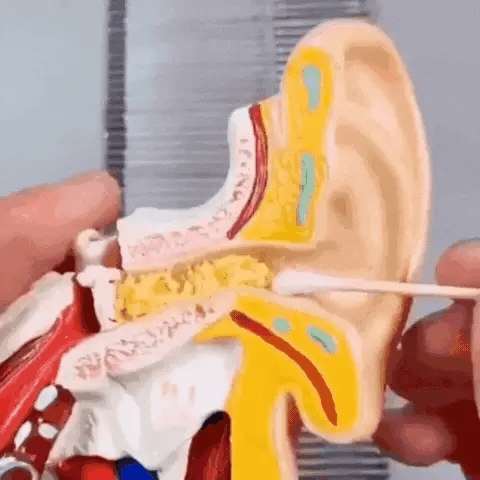 OtoClean™| Kit de Nettoyage Oreille Réutilisable (1 Acheté = 1 OFFERT) - Bingoo