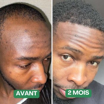 Silken®| Huile de Croissance des Cheveux  (1 Boîte = 1 Mois d'utilisation)