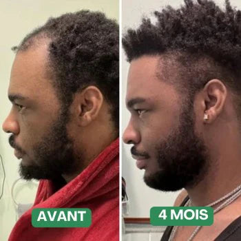 Silken®| Huile de Croissance des Cheveux  (1 Boîte = 1 Mois d'utilisation)